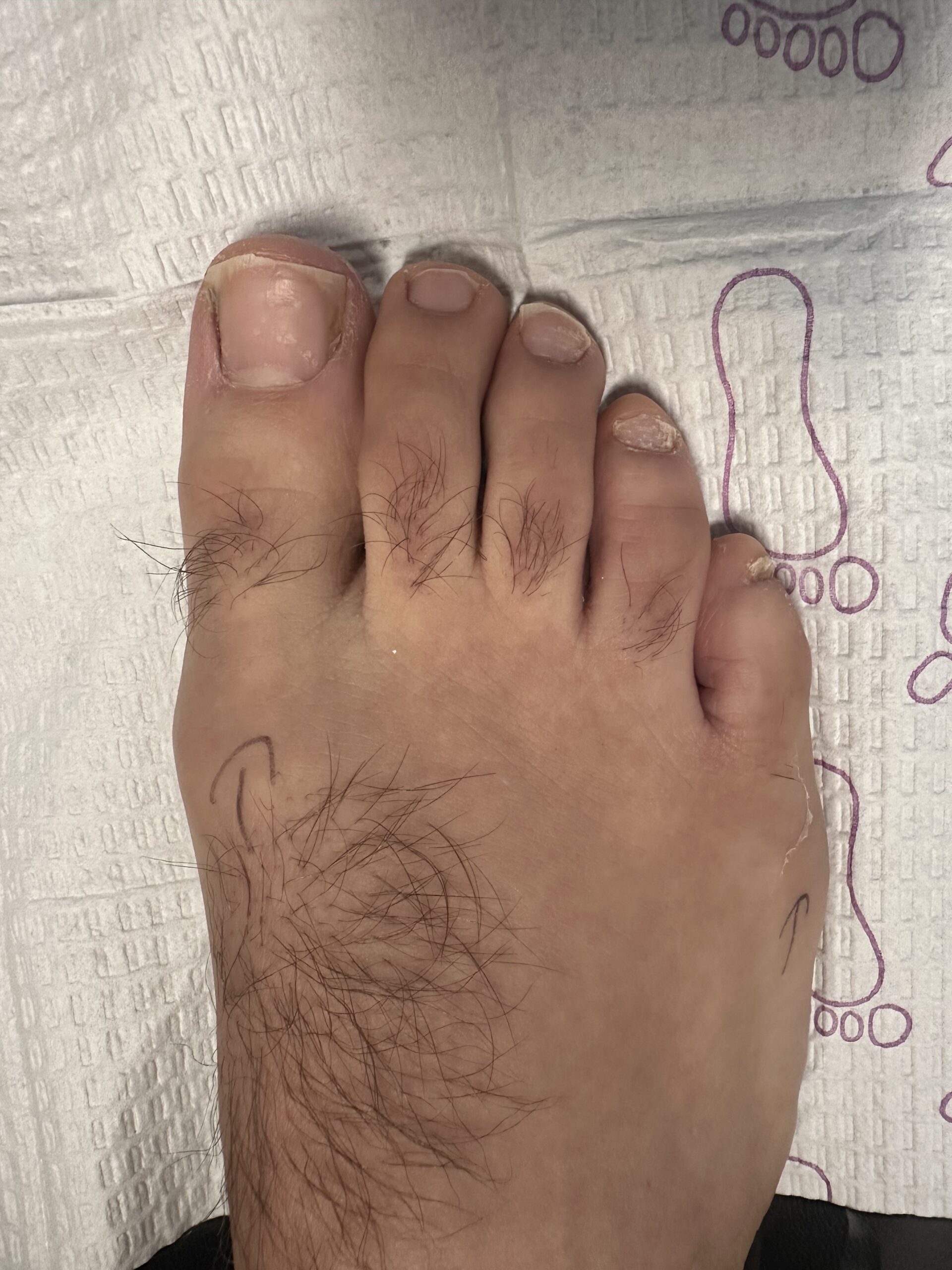 Before surgery photograph showing mild bunionette deformity and first metatarsophalangeal joint arthritis causing chronic foot pain in a marathon runner.