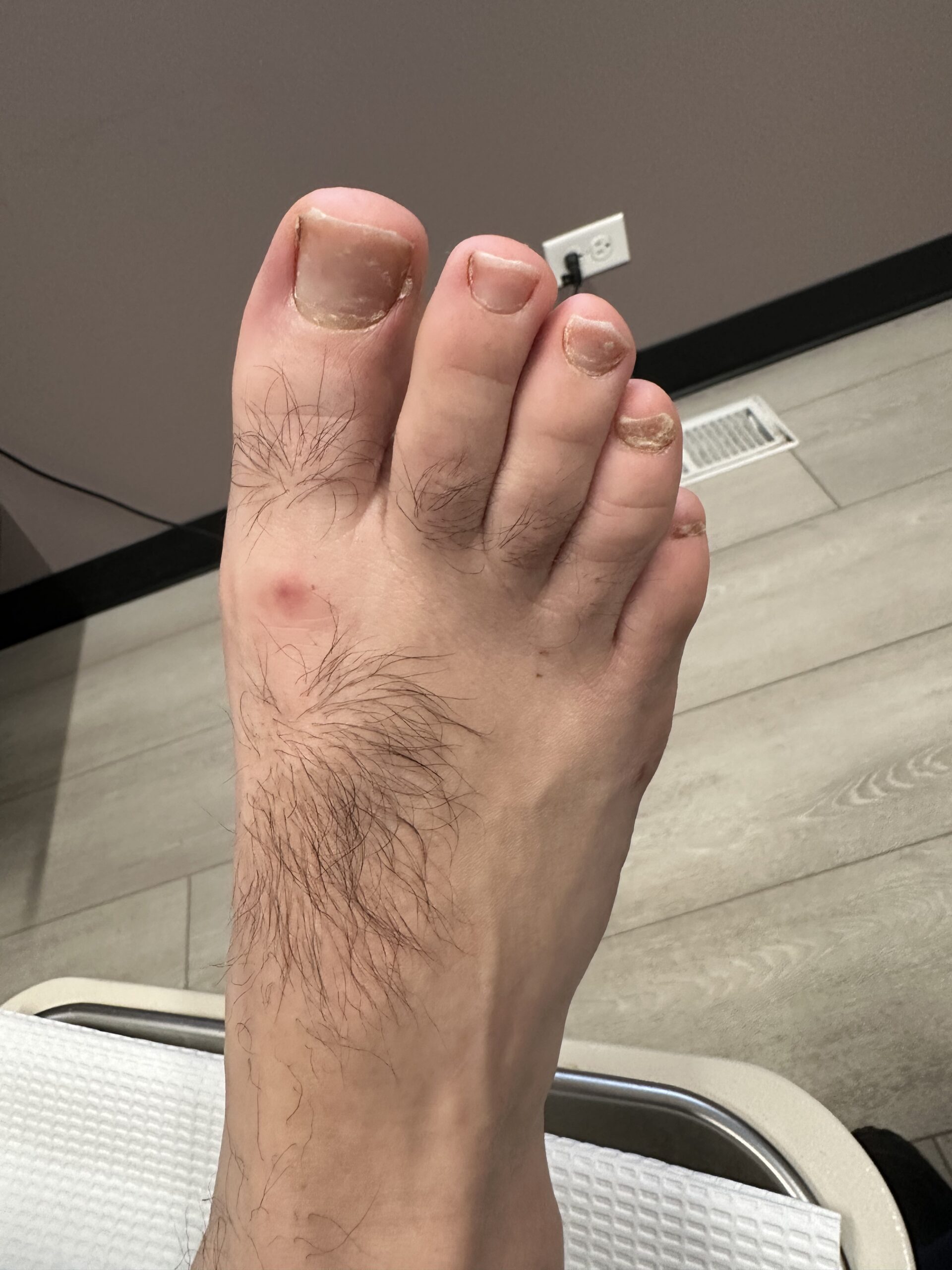 4 weeks after minimally invasive bunionette correction and first metatarsophalangeal joint decompression with healing incision and early return to regular shoes.