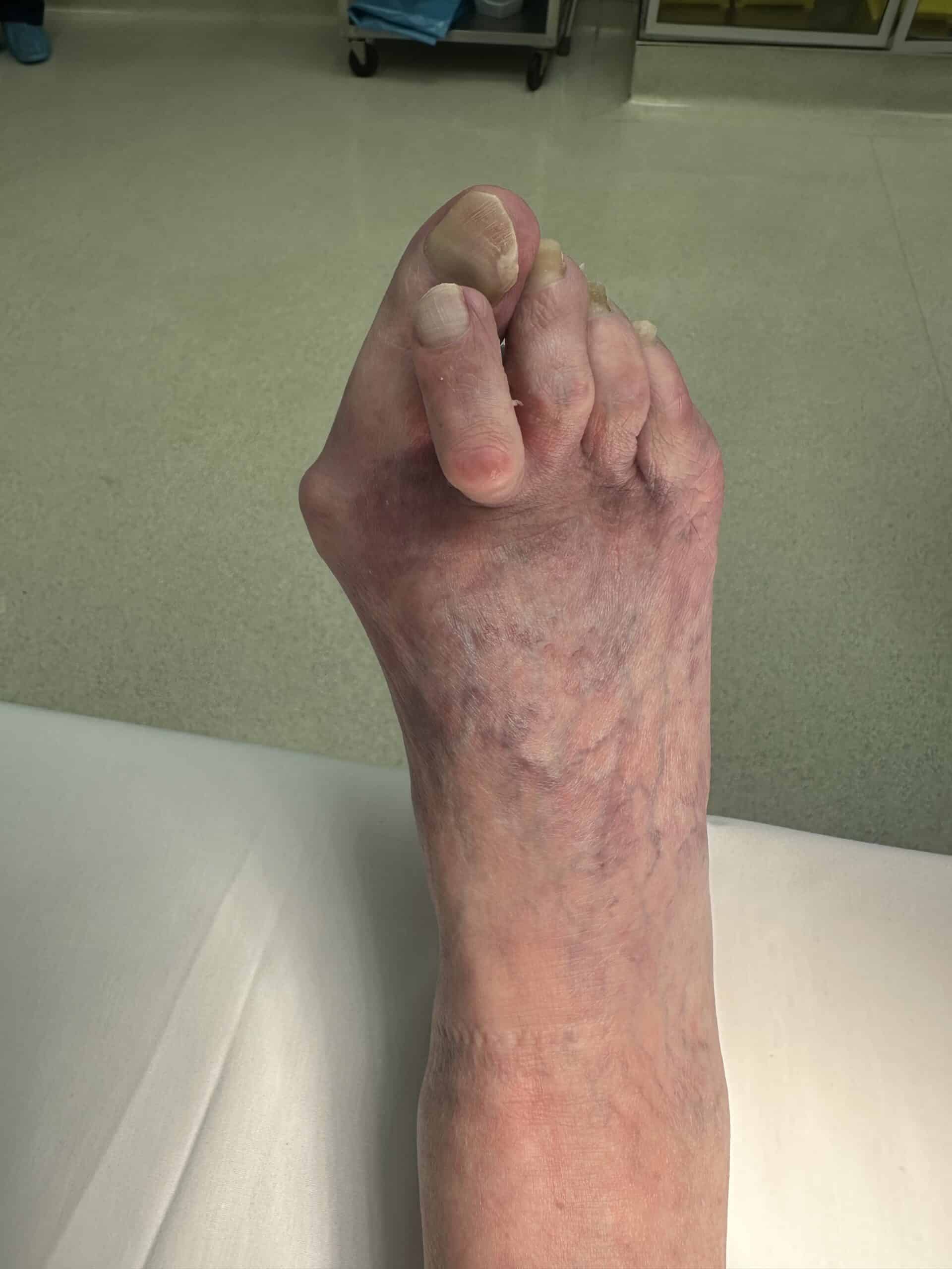Severe bunion with crossover second toe, hammertoe deformity, and painful forefoot before minimally invasive reconstruction