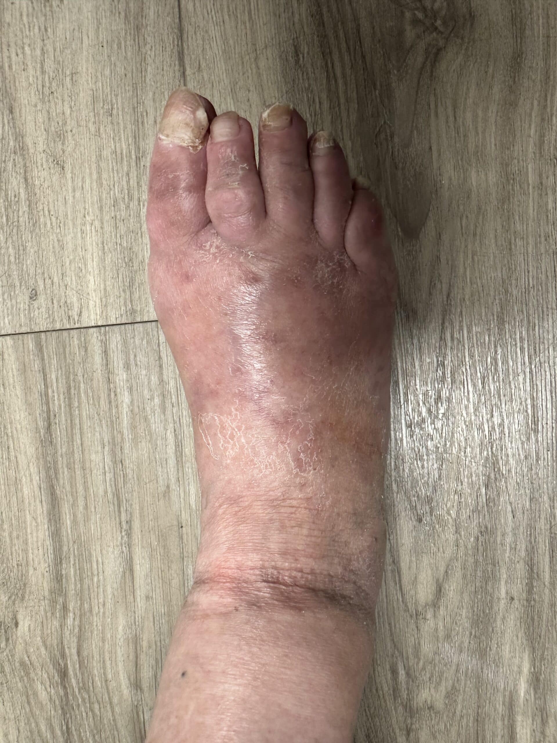 Five weeks after minimally invasive bunion and hammertoe reconstruction with improved alignment and expected postoperative swelling