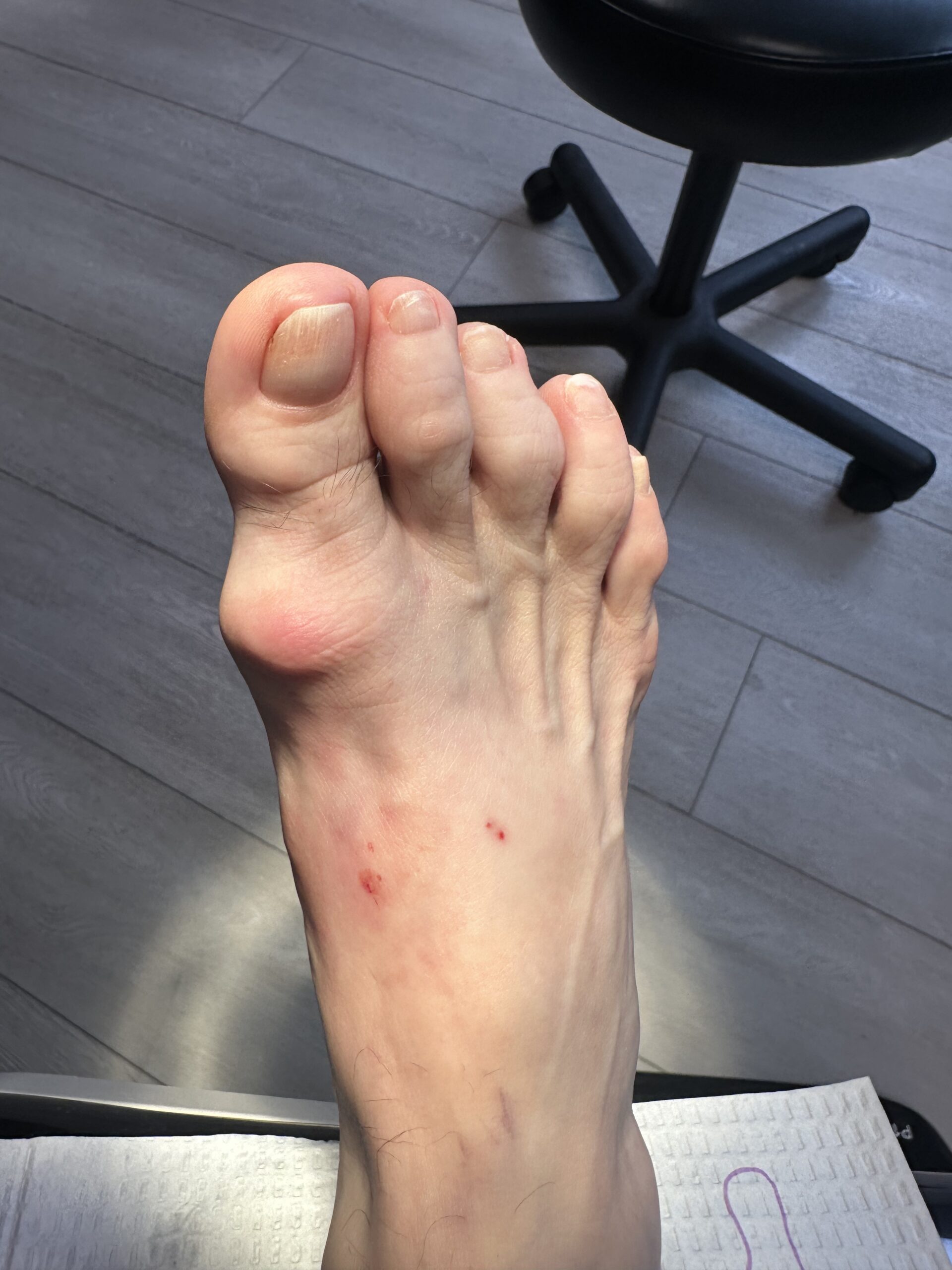 Arthritic big toe joint