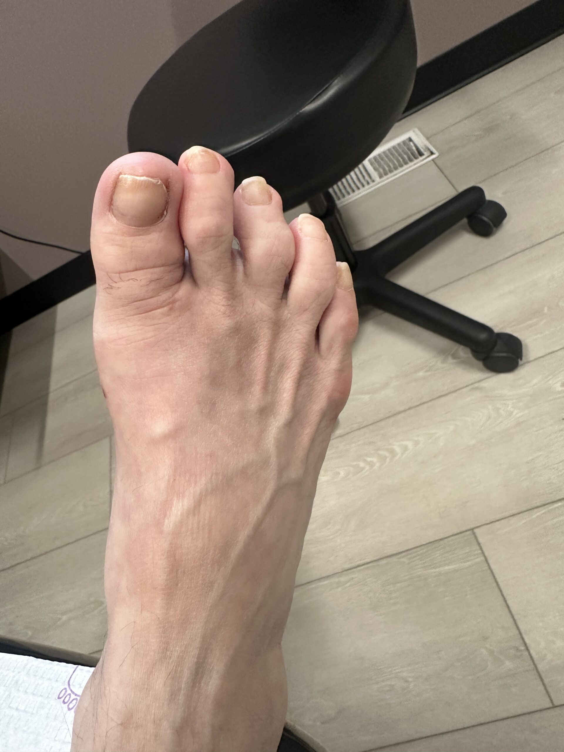 Post op photo of arthritic toe joint after MIS correction